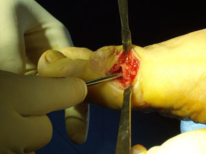 Corrección mediante desplazamiento lateral del fragmento capital.