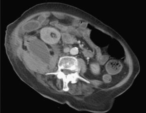 Imagen de la tomografía computarizada en la que se observa el extenso hematoma que incluye los músculos psoas-ilíaco y cuadrado lumbar derechos.