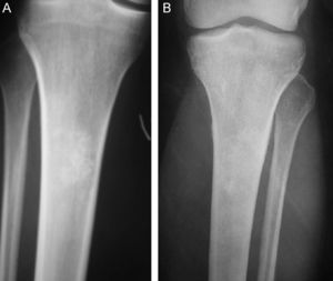 Imagen de lesión condral en la tibia proximal, en la que las calcificaciones cambian con el paso del tiempo. A) Imagen de 1994. B) Imagen de 2000.