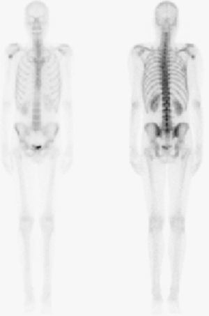 Imagen en gammagrafía ósea de lesión cartilaginosa del húmero proximal que muestra una captación superior a la fisiológica en espinas ilíacas. Resultó ser condrosarcoma de bajo grado.