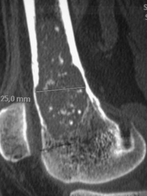 Imagen en tomografía computarizada de erosión de la cortical interna de una lesión cartilaginosa del fémur distal. En la biopsia se diagnosticó como condrosarcoma de bajo grado.