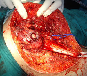 Imagen intraoperatoria del tumor.