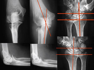 Caso 6: resección de la cabeza radial, radiografías iniciales de la fractura y al final del período de seguimiento del codo (mostrando la desviación en valgo) y bilateral de muñecas (mostrando la migración proximal del radio).