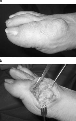 Prominencia ósea dorsal característica del hallux rígidus. a) Aspecto clínico del pie. b) Durante la cirugía.