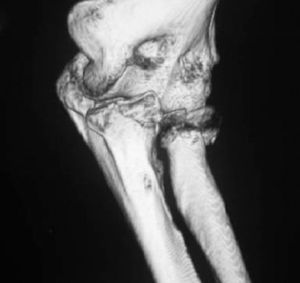 La tomografía axial computarizada (TAC) es fundamental en la valoración preoperatoria de estas lesiones y nos ayuda a entender mejor cuales son las estructuras afectadas y como podemos encarar su reparación.
