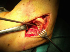 Reparación de la cápsula anterior en una fractura de la punta de la coronoides con un arpón. El acceso es posible desde un abordaje lateral incluso sin la extirpación de la cabeza radial.