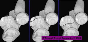 Clasificación de O′Driscoll de fracturas de ala apófisis coronoides basada en su morfología según la TAC.