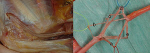 Disección intraneural del nervio cubital proximal al codo y en su paso por el canal de Osborne. a) fascículo para rama superficial; b) fascículo para la rama profunda; c) fascículo para el músculo flexor digitorum profundus; d) fascículo para la rama dorsal, y e) fascículo para el músculo flexor carpi ulnaris).