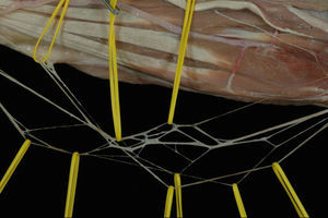 Disección intraneural del nervio cubital en el antebrazo en la que podemos apreciar la gran cantidad de comunicaciones interfasciculares existentes.