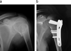 Imagen a) prequirúrgica y b) posquirúrgica de fractura proximal de húmero con osteosíntesis estable en mujer de 34 años con fractura en 2 fragmentos.