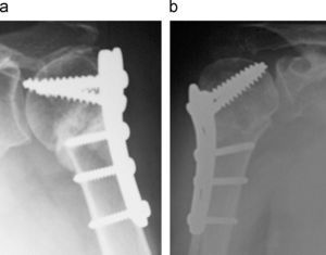 Complicaciones por protusión articular de tornillos en: a) mujer de 69 años con fractura en 3 fragmentos, y b) varón de 55 años con fractura en 2 fragmentos.