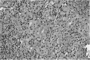 Proliferación de células endoteliales epitelioides con citoplasma amplio y eosinófilo. Núcleos vesiculares con nucleolos eosinófílicos. HE 20×.