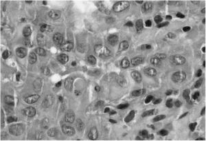 Detalle de núcleos vesiculares grandes vesiculares con nucleolos eosinofílicos. HE 60×.