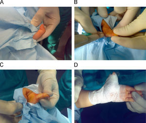 A) Vista clínica prequirúrgica dedo pulgar de la mano derecha en resorte. B) Inserción de la aguja en la vaina del tendón a nivel de la polea A1. C) Extensión máxima del pulgar tras la liberación. D) Se coloca un vendaje con el pulgar en extensión máxima.