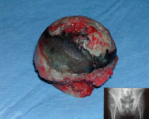 Artropatía ocronótica de cadera: imagen macroscópica de la cabeza femoral y radiografía a-p de ambas caderas.