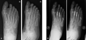 Pseudoartrosis tras osteotomía distal percutánea de los radios menores ...