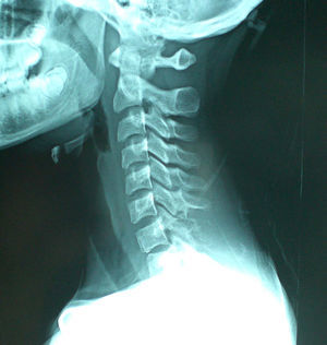 Radiografía cervical lateral.