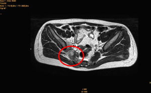 Imagen de la resonancia nuclear magnética de zona pélvica de paciente de 12 años con piomiositis del músculo piriforme debido a Staphylococcus aureus. El músculo piriforme derecho (círculo) se visualiza aumentado de tamaño y edematoso.