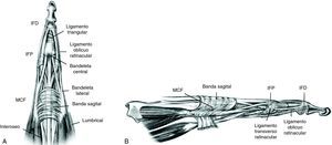 Anatomía normal de la articulación MCF y de las bandas sagitales del mecanismo tendinoso extensor. A) visión frontal; B) visión lateral. IFD: articulación interfalángica distal; IFP: articulación interfalángica proximal; MCF: articulación metacarpofalángica.