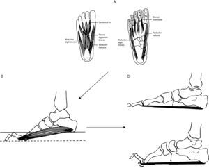 Partiendo de imágenes tomadas del Sabir y Lyttle38y de los hallazgos RM de la musculatura de pie41, interpretación fisiopatológica del pie cavo en estadios precoces de CMT1A. (A) La enfermedad se inicia con la desnervación de lumbricales y de otros músculos intrínsecos del pie. (B) La paresia de lumbricales origina dedos en garra, aplanamiento del arco plantar anterior y contractura de los músculos flexores cortos aproximando los pilares del arco longitudinal del pie. (C) Durante la marcha, antes de despegar los dedos, con la extensión de las articulaciones metatarsofalángicas, la aponeurosis plantar se enrosca alrededor de las cabezas metatarsianas (efecto cabrestante) aproximando todavía más los pilares del arco longitudinal del pie y acortando el tendón de Aquiles, lo cual limita la dorsiflexión del pie.