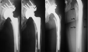 A) Radiografía postquirúrgica a la edad de 26 años. B) A cuatro años de seguimiento. C) Radiografía postquirúrgica tras el recambio del vástago. D) Un año tras el recambio.