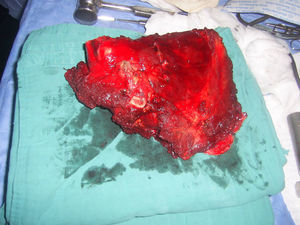 Escapulectomía total en un sarcoma de Ewing.