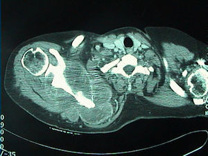 Condrosarcoma de la escápula izquierda con osteolisis de la cortical.