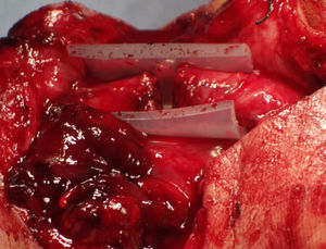 Resección de los extremos nerviosos, afrontamiento y posterior fijación perineural y cierre del tubo.