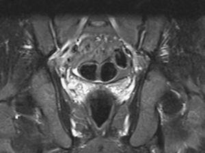 Corte coronal de RM de pelvis en secuencia T2 STIR, sin hallazgos patológicos en ambas articulaciones sacroilíacas al ingreso.