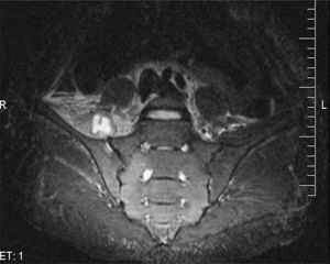 Corte sagital de RM de pelvis, en la secuencia T2 STIR, 5 días después del ingreso, con aumento incipiente del espacio articular en la sacroilíaca derecha y una colección líquida adyacente en el espesor del músculo psoas.