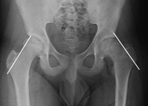 Radiografía de pelvis, AP que muestra epífisis bajo la línea de Klein en la cadera izquierda, signo radiológico de epifisiolisis.