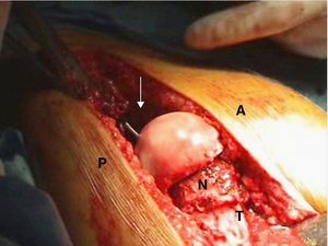 Cabeza femoral reposicionada. A: anterior, P: posterior, N: cuello femoral, T: trocánter mayor. La flecha muestra el acetábulo.