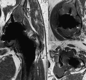 Caso 32. Granuloma extenso con continuidad de la afectación ósea y articular. Izquierda: corte frontal. Arriba derecha: corte sagital. Abajo derecha: corte transversal.