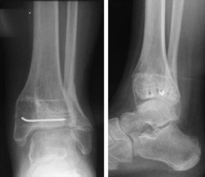 Radiografías anteroposterior y lateral de la misma paciente donde se puede observar la corrección angular mantenida a los tres años de realizar la distracción fisaria.
