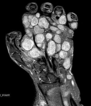 Imagen de RM potenciada en T2 donde se aprecian las múltiples tumoraciones a nivel de superficie volar de mano y antebrazo derecho.