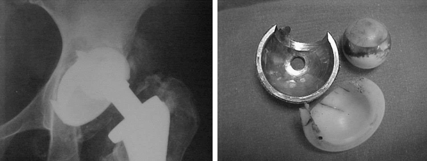 Desgaste catastrófico del componente acetabular en prótesis total de ...