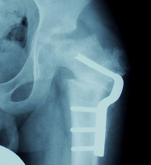 Osteotomía valguizante en una cadera en bisagra.