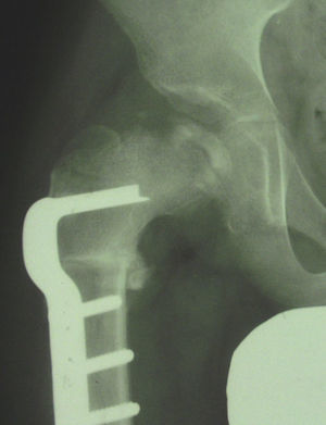 Osteotomía varizante de fémur.