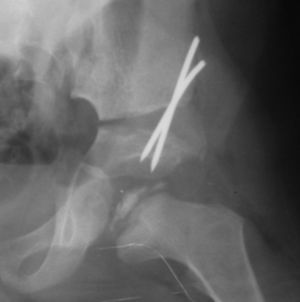 Osteotomía pélvica de Salter en la cadera izquierda.