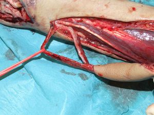 Disección de una vena en el colgajo interóseo posterior, con tejido celular subcutáneo e intersticio.