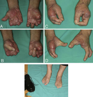 A), B) Mano metacarpiana bilateral remitida a los 5 meses de la lesión. C), D) En mano izquierda se trasplantó el dedo gordo del pie al pulgar y se resecaron los muñones de los metacarpianos 2 y 3 para proporcionar una buena comisura. La mano derecha se reconstruyó mediante transferencia de un colgajo microvascular lateral del muslo y una transferencia de un tándem de 2.° y 3.er dedo de pie, en la misma intervención. E) Zona donante a los 4 años de la intervención del caso 2. El paciente refiere caminar todos los días al menos 10km. Nótese que utiliza un calzado normal.