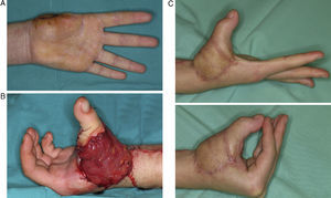 A) Amputación de pulgar a la altura de la articulación trapeciometacarpofalángica. B) Transferencia simultánea de un dedo del pie más un colgajo microvascular de músculo gracilis para cobertura. C) Resultado final.