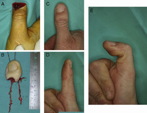 A) Amputación de pulgar distal a la articulación interfalángica. B) Primer dedo del pie modificado según técnica de Wei (trimmed toe). C) D) E) Resultado.