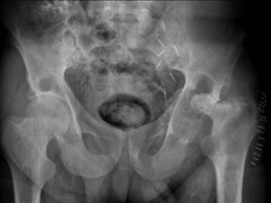 Rx AP de pelvis en la cual se observa una marcada osteólisis de la parte superior del acetábulo y destrucción global de la cabeza femoral.