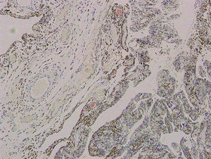 Corte anatomopatológico de membrana sinovial, en el cual se observa captación con rojo Congo.