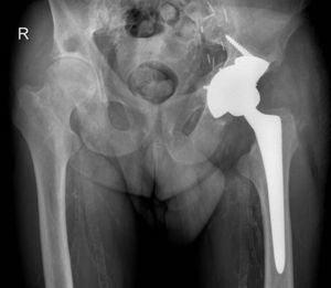 Resultado radiológico de artroplastia total de cadera con uso de suplemento de tantalio.