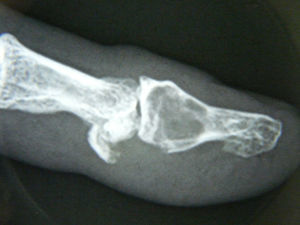 Imagen radiológica de lesión lítica con el arrancamiento del flexor.