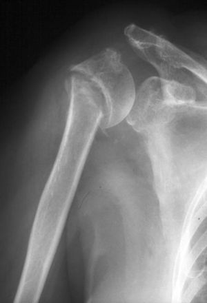Radiografía anteroposterior de hombro derecho en la que se aprecia pseudoartrosis de húmero proximal tras fractura en 2 partes con reabsorción ósea del fragmento cefálico.