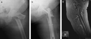 Caso clínico n.° 1. Fractura atípica subtrocantérica de fémur: a) radiografía postfractura; b) radiografía postenclavado endomedular, y c) RMN de fémur contralateral.