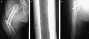 Caso clínico n.° 2. Fractura atípica medio-diafisaria de fémur: a) radiografía postfractura; b) detalle de la radiografía prefractura, y c) radiografía postenclavado endomedular.